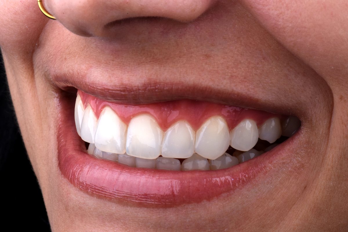 Sorriso restaurado com lentes